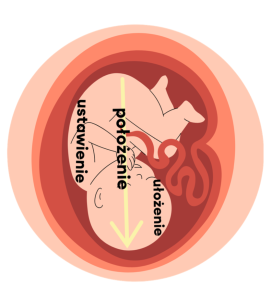 Położenie miednicowe dziecka - kiedy i jak rozpocząć pracę terapeutyczną? 1 ulozenie miednicowe dziecka